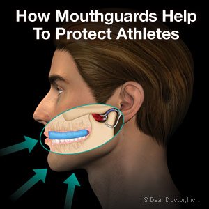 How Mouthguards Work Image