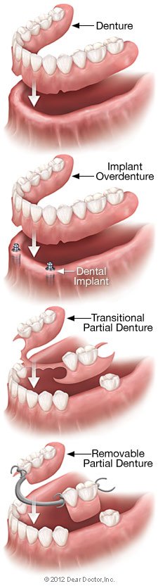 Types of full and partial dentures comparison