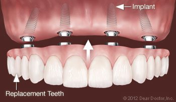 Image displaying what a fixed denture is
