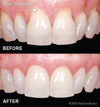 Before and After Gum Grafting