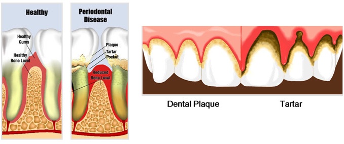 Periodontal Disease Comparison to Healthy Teeth